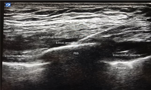 Figure 1. Spread of LA between the serratus anterior muscle and the underlying rib.