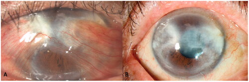 Clinical Photograph 2. Anterior segment photo of a kissing double-headed pterygium (A) with preoperative unrecordable astigmatism and Hand movement vision. Astigmatism improved to −5.5D postoperatively (B) with a best-corrected visual acuity of 6/12 despite significant residual scarring.