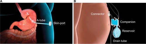 Figure 2 Aspire Bariatrics AspireAssist.