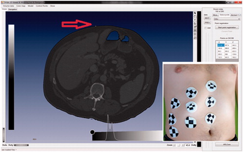Figure 4. With markers attached (right) that are visible on CT images (left), with nine markers attached to the patient.[Citation10].
