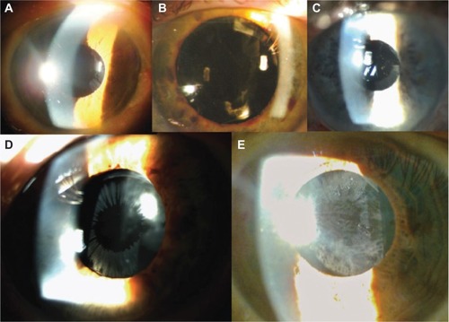 Figure 1 Deposition of XFM on the anterior surface of posterior chamber intraocular lenses.