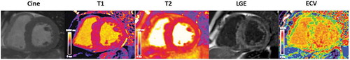 Figure 4. Cardiac MRI short axis steady-state free precession cine (left to right) with corresponding native myocardial T1 map, corresponding myocardial T2 map, corresponding phase sensitive inversion recovery reconstruction late gadolinium enhancement image and corresponding ECV map
