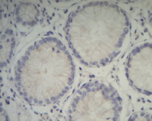 Figure 6 Negative expression of Piwil2 in para-carcinoma tissue, ×400.