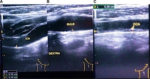 Figure 2 Sonographic examination of carotid arteries in one patient, from this figure we can see intima-media thickness measurement, carotid bulb measurement, and spectral Doppler.