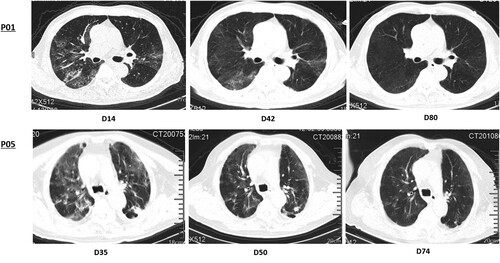 Figure 2. Series of chest CT presentation in patients with prolonged positive PCR results. Both patients did not present with any clinical symptoms. P01 showed typical changes of fully recovery, and P05 showed partial improvement at the time of evaluation.