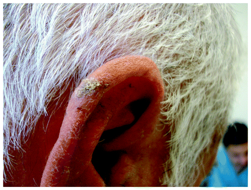 Figure 5. Histologically confirmed SCC on right helix of an elderly man.