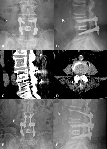 Figure 3 Case 2. A 63-year-old female had undergone L4/5 fusion 5 years prior. She had experienced radiating pain of the left lower limb for half a year and was diagnosed with ASD of L3/4. (A and B) Preoperative X-ray showed the original pedicle screws and cage in L4/5. (C and D) Preoperative CT revealed L3/4 intervertebral disc herniation. (E and F) X-ray after the surgery showed good positioning of the CBT screws.