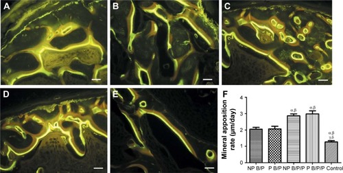 Figure 8 Mineral apposition rates.Notes: Images of fluorescence double staining for tetracycline (yellow) and calcein (green) in the defects implanted with (A) NP B/P scaffolds, (B) P B/P scaffolds, (C) NP B/P/P scaffolds, (D) P B/P/P scaffolds (E), or control group without implanted scaffolds; scale bars: 100 μm. (F) Mineral apposition rates for NP B/P scaffolds, P B/P scaffolds, NP B/P/P scaffolds, and P B/P/P scaffolds. Results are mean ± standard deviation (χ ± SD), n=3; αP<0.05 vs NP B/P scaffolds; βP<0.05 vs P B/P scaffolds; γP<0.05 vs NP B/P/P scaffolds; δP<0.05 vs P B/P/P scaffolds.Abbreviations: NP B/P, nonprinted biphasic calcium phosphate/polyvinyl alcohol; NP B/P/P, nonprinted biphasic calcium phosphate/polyvinyl alcohol/platelet-rich fibrin; P B/P, printed biphasic calcium phosphate/polyvinyl alcohol; P B/P/P, printed biphasic calcium phosphate/polyvinyl alcohol/platelet-rich fibrin.