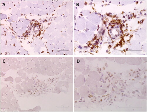 Figure 3. IL-8 expression by macrophages in the muscle tissue. (A–D) Immunohistochemical stainings for CD68 (A, B), a marker of macrophages, and IL-8 (C, D) were performed in frozen sections of the muscle biopsy from our case. Bar scales represent 100 µm.