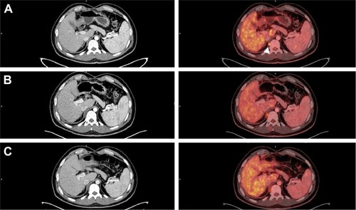 Figure 2 PET/CT Citation18F-FDG scan of the retrocrural adenopathy at the level of the 11th right dorsal vertebra.