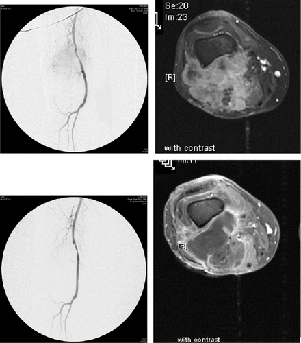 Figure 1. Male, 54 years; repeatedly operated for popliteal entrapment, finally evolving a big lump in the popliteal fossa (high grade leiomyosarcoma). Recommended TM-ILP to achieve limb salvage. Angiogram and dynamic MRI (upper panel). Complete and tumour-specific deterioration of the vasculature eight weeks following ILP with complete corresponding necrosis of the tumour (lower panel). Subsequent marginal resection revealing a complete histopathologic necrosis. Restoration of soft tissue with a microvascular latissimus dorsi flap.