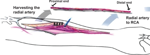 Figure 1 Schematic representation of the proximal and distal ends of the radial artery.