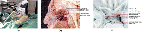 Figure 1. Endoscopic trans-nasal pituitary surgery: (a) OR set-up; (b) sagittal image of the head featuring the pituitary gland, parasellar bones, brain and cranium; (c) oblique image featuring the pituitary gland and surrounding critical tissues (reproduced with permission from reference Citation[2]). [Color version available online.]