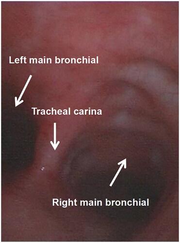 Figure 8. This is a Picture of the tracheal mucosa in group II, and it can be seen that the carinal and main bronchial mucosa have very little hemorrhage, damage, or edema.