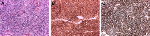 Figure 2 Gastrointestinal stromal tumor cell histology.