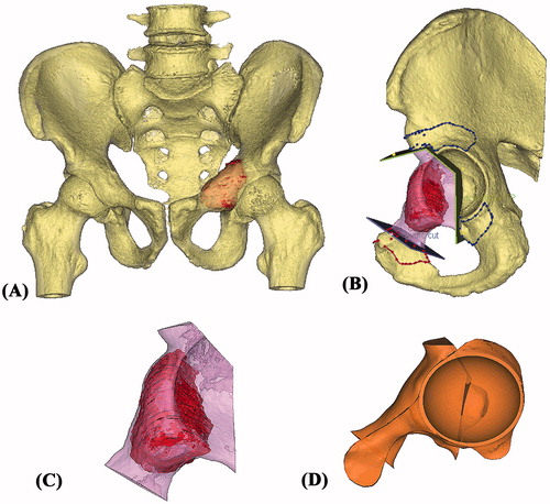 Figure 2. (A) The 3D pelvis was segmented by the thresholding process in the CAD software. The extent of tumor was outlined on each axial CT image and its tumor volume was extracted (red in color). A 3D bone tumor model was created for the surgical planning. (B) Surgeons performed the virtual resections by defining the locations and orientations of the resection planes. The planes were 1 mm in thickness, the same as that of the oscillating saw used during the actual surgery. The footprints at where the PSI was positioned were marked on the bone surface (red and blue lines). The working file of the surgical plan was then sent to the implant engineer for the design of the implant and PSI. (C) The virtually resected tumor was extracted. As the bone was deformed by the tumor, the mirrored 3D image from the normal side of the hemipelvis was used to duplicate the core shape of the implant. (D) The flanges and the acetabular cup were added for better implant stability. The final implant design had a normal acetabular contour and the components for implant fixation.