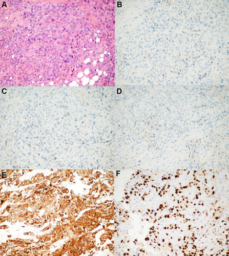 Figure 1 The pathological results of the rebiopsy pathology of the right breast tumor performed in our hospital. (A) Hematoxylin–eosin-stained sections revealed that the tumor cells grew in a solid and patchy infiltrating manner (original magnification: 200×). (B–D) ER, PR, and HER-2 were negative for neoplastic cells by immunohistochemical analysis (original magnification: 200×). (E) CK5/6 was strongly expressed by tumor cells (original magnification: 200×). (F) Ki-67 was expressed in the nuclei of approximately 50% of tumor cells (original magnification: 200×).