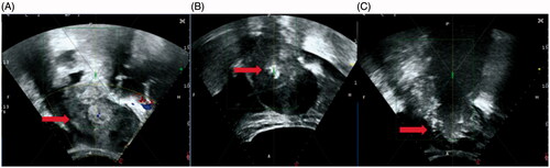 Figure 1. The real-time ultrasound image obtained from a 46-year-old patient with metastatic pelvic tumor from endometrial cancer. (A). A pre-HIFU ultrasound image showed a recurrent lesion of 112 cm × 72cm × 71cm, with mixed echoic (arrow); (B). During HIFU treatment, a significant gray scale changed area was observed in the pelvic lesion (arrow); (C) ultrasound image obtained at 1301 s of sonication showed the gray scale changed area covered the pelvic lesion (arrow).