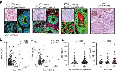 Figure 1. CD73 expression in CRLM and soluble CD73 serum level. (a) Representative examples of CD73 detection by multiplex immunofluorescence, near absent (left) and high in the stroma and within lumens of cancer pseudoglands. By immunohistochemistry (IHC), detection of membrane-bound CD73 on the apical border of cancer pseudoglands (arrow) in conjunction with shed or immune-cell bound detection within pseudogland lumens (right). Hematoxylin and eosin staining are shown for morphological reference in upper left corners. Bars represent 50 μm. (b) Correlation between percent necrotic CRLM surface area and intratumoral CD73 detection (tCD73). (c) Correlation between soluble CD73 (sCD73) serum level and tCD73. (d) tCD73 levels according to pre-operative chemotherapy status (left) and histologic pathological response to chemotherapy, assessed by the Tumor Regression Grade (TRG) system, where 1 represent complete response and 5 absence of response. Correlations assessed with Spearman method. Means compared with Mann-Whitney test and One-Way ANOVA test. MFI, Mean Fluorescence Intensity; CK, Cytokeratins; DAPI, 4ʹ.6ʹ-Diamidino-2-Phenylindol