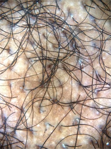 Figure 5 Trichoscopy of acute traction alopecia demonstrates black dots and broken hairs at different length. In this example, the patient is presented with marginal hair loss after removal of a glued wig.