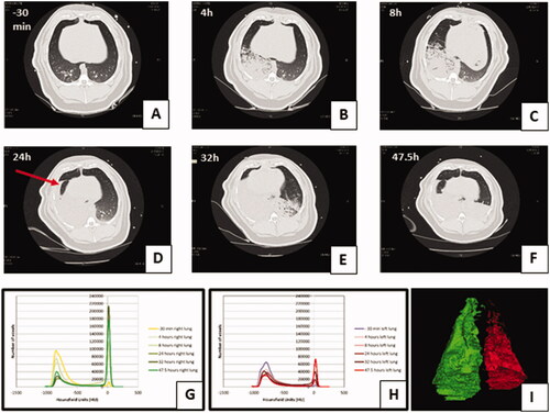 Figure 4. Lung injury caused by instillation of OP + GJ shown through serial CT scans and lung density analysis. Serial CT scans of an OP + GJ pig before (A) and after (B–F) instillation of a mixture of OP + GJ into the right lung of a minipig at time = 0, with voxel density analysis of the directly-injured (G) and indirectly-injured (H) lungs over time. Panel I shows only the non-aerated voxels (–250 to +250 HU) 47.5 h after instillation of OP + GJ in the right, directly-injured lung compared with the left, indirectly-injured lung. By 4 h (B), there is an obvious right-sided lower area of consolidation which enlarges over time to involve most of the right lung by 24 h (D) with a large pleural effusion seen in the fissure (arrow). By 32 h, the contralateral left lung is also involved showing dorsal consolidation (E) which worsens with bilateral pleural effusions at 47.5 h (F). The right lung recovers slightly at this time with more aeration sub-sternally (anteriorly). Indirectly-injured (left) lung (H) is represented in red, directly-injured (right) lung (G) in green in the online version. Directly-injured lung has a peak amount of poorly aerated lung at 32 h, which then reduces a little by 47.5 h, mirroring the CT images. The indirectly-injured lung has less volume than the contralateral lung at baseline, hence the smaller peaks. However, the spread of voxels shows a good proportion of well-ventilated, aerated lung at 47.5 h, unlike in the directly-injured lung.