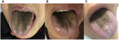 Figure 1 The black tongue coat on the patient tongues. (A) Patient 1; (B) Patient 2; (C) Patient 3.