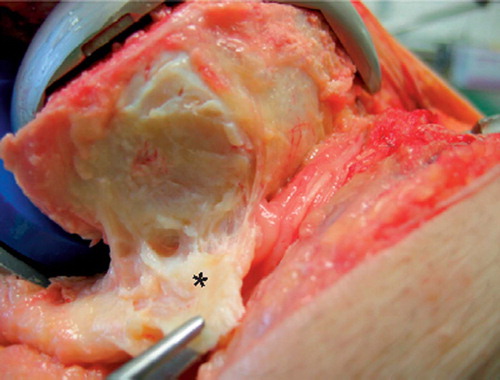 Figure 4. Subperiosteal release of the femoral attachment of the medial collateral ligament with the trial components in situ. (*) medial collateral ligament.