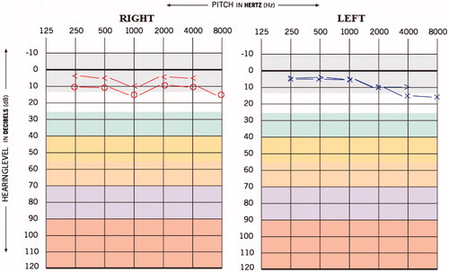 Figure 3. Pre-medication audiogram of case 2.