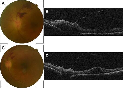 Figure 2 Baseline fundus photo (A) of the left eye of patient #3 displaying papilledema with retinal hemorrhage along the superotemporal retinal vein. OCT scan shows elevation of the optic disc, an epiretinal membrane, posterior vitreous detachment (PVD), and slight thickening of the macula (B). Post-treatment imaging depicts almost complete resorption of the papilledema (C), substantial resorption of the retinal hemorrhage (C), significant reduction in optic disc elevation (D), PVD, and a macular serous detachment (D).