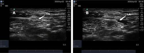 Figure 2 Needle tip position for measurement of the stimulation threshold (A) and local. Anesthetic (B).