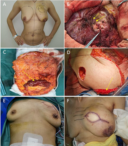Figure 1 Sequential Stages of the DIEP Breast Reconstruction Surgical Procedure. (A) The initial stage involves preoperative markings which denote the tumor location and the range for flap excision. (B) This image highlights the vessels in the recipient area: The intra-thoracic arteries and veins are revealed within the 3rd rib space, as shown by arrows indicating 1 artery and 1 accompanying vein. (C) Post the freeing of the donor flap, the primary trunk of the subabdominal vessels becomes visible. A small section of the rectus abdominis muscle is observed wrapping around the vessel tips, also indicated by arrows. (D) After the vascular anastomosis, the image, guided by arrows, illustrates the flap edges exhibiting bleeding but with good blood flow after the removal of the epidermis. (E) Here we see the reconstructed breasts post shaping, with the bilateral breasts demonstrating basic symmetry. (F) The final image shows the status of the flap 1–5 days post-surgery, with a stable blood flow apparent.