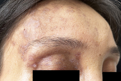 Figure 2 A band-like distribution of lichen planus-like lesions was observed on the right forehead, and the right eyelid was heavily pigmented.