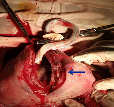 Figure 2 Vertical trans fundal incision made without disrupting the placenta. Incision (arrow) following the delivery of the fetus.