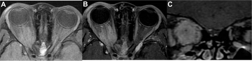 Figure 4 MRI of orbit (case 1). (A) Axial T1-weighted, (B) axial T1-weighted with gadolinium injection, and (C) coronal T1-weighted with gadolinium injection showing diffuse enlargement and contrast enhancement of the right intraorbital optic nerve sheath.