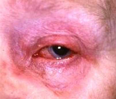 Figure 8 Contact allergic blepharoconjunctivitis (pilocarpine eyedrops).