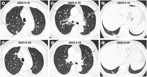 Figure 4. Changes in chest computed tomography images of the patient treated with antifungal therapy within 1 month. (A–C) Chest CT images after 9 days of antifungal treatment. (D–F) Chest CT images after 23 days of antifungal treatment.CT: Computed tomography.
