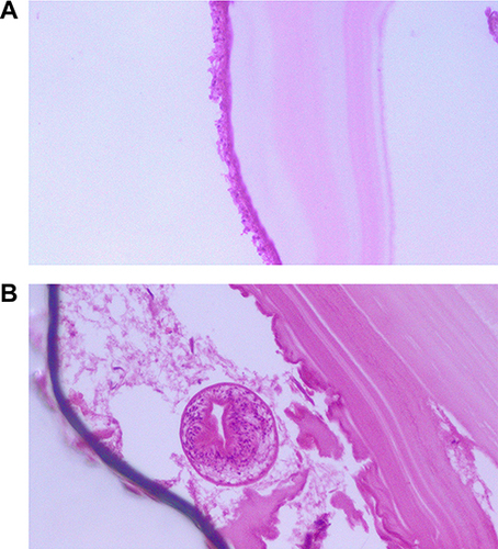 Figure 2 A slide showing acellular laminated membrane with germinal epithelium (A) and a daughter cyst with protoscolices (B).