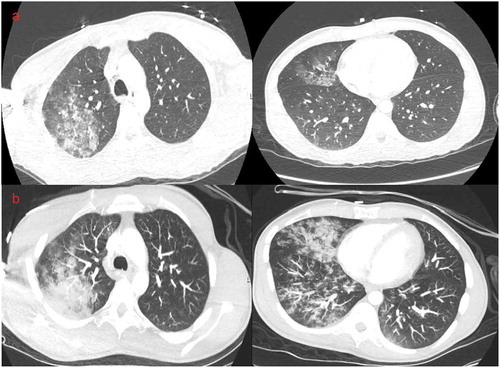 Figure 1. (a) CT angiogram of the chest at the time of presentation showing right upper and lower lobe opacities. (b) 12 h repeat CT angiogram showing worsening of the opacities of right upper and lower lobes, with new left lower lobe opacity