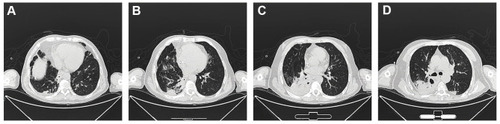 Figure 2 Computerized tomography was carried out on Day 23 after hospitalization. The dense consolidation and the inflammation of the cavity wall were reduced comparing with the first CT images.