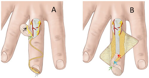 Figure 1. Schematic illustration of the use of HDNBPIF in treating fingertip amputation. HDNBPIF is designed and superficial skin channel is cut like shown in (A). Black arrow shows the dissected digital nerve in flap. Green arrow shows the broaden pedicle. Grey arrow shows the stump of the proper digital nerve. We rotated the flap with the flap’s vascular nutrient stripe and the broaden pedicle is also shown in (B). Red arrow shows the pivot point. Green arrow shows the rotated broaden pedicle. Blue arrow shows the nutrient stripe of flap.