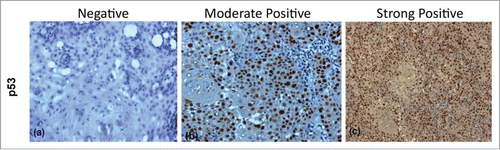 Figure 2. Figure showing Immunohistochemical expression of p53 in OSCC (A) showing negative nuclei (B) showing moderately positive stained nuclei (C) showing strongly positive stained nuclei (DAB x 125 x digital magnification).
