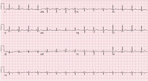 Figure 1 Electrocardiogram.