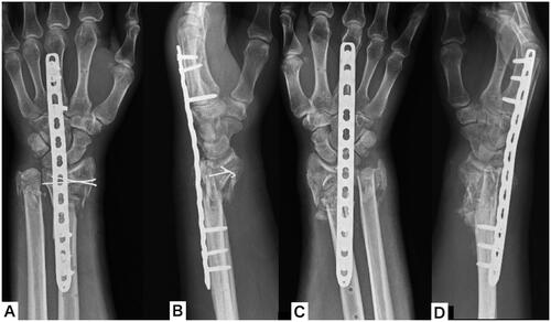 Figure 4. Plain x-ray of both wrists after distraction plating. (A,B) Plain x-ray of the left wrist; (C,D) plain x-ray of the right wrist.