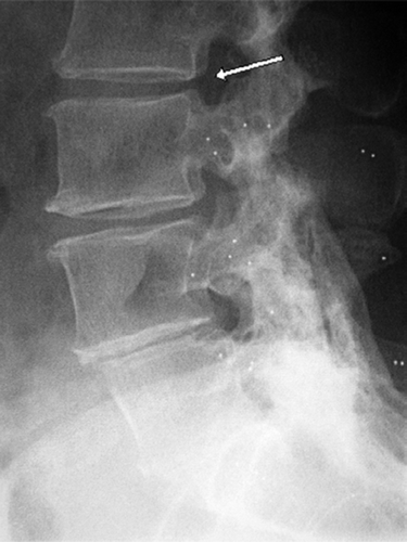 The Case 1, 3 years after fusion of the L4–S1 level. The patient had relapsing symptoms, but at that time no degeneration of the L2–L3 segment proximal to the segment adjacent to the fusion. Tantalum indicators can be seen placed in L3 and distally.