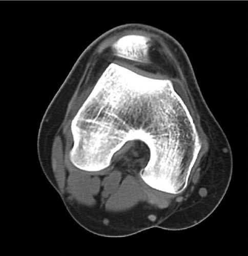 Figure 5. Preoperative axial CT scan with a flat trochlea.