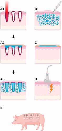 Figure 1. Drug delivery methods. Schematic diagram showing sections of skin and the different drug delivery interventions used in this study. Series A depicts a complete laser-assisted topical drug delivery method consisting of three steps: (A1) Ablative fractional laser (AFL) treatment ablates the skin with precise microbeams to create laser channels. The coagulation zones are shown in dark red; (A2) Topical application on AFL-treated skin. An adhesive well-system is applied to the surface of the lasered skin and filled with a bleomycin (BLM) solution; (A3) The adhesive well-system is removed. BLM builds up in the channels, saturates the coagulation zones, and disperses into the surrounding skin. B: BLM is injected intradermally using a conventional needle and syringe. C: Topical application on intact skin. An adhesive well-system containing BLM is applied to the surface of intact skin. D: Skin is electroporated by inserting a needle probe and firing multiple high-frequency pulses. E: Sample areas were located on the back and flanks of each pig. Interventions were distributed evenly to control for differences in skin thickness. Diagrams are not to scale.