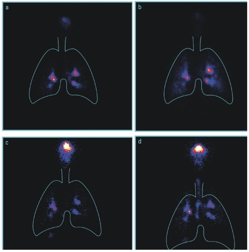 Figure 3 Samples of scintigraphic images from a patient showing deposition pattern from Respimat® Soft Mist™ Inhaler before training (a) and after training (b), and from pMDI before training (c) and after training (d).