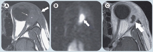 Figure 4. An 11-year-old girl with orbital cellulitis and extraconal abscess.(A) Axial T1 weighted image shows a well-defined area of isointense signal (thick arrow) with focal mass effect and globe distortion medially (thin arrow), and a subtle area of internal high signal intensity (*) that suggests the lesion is complex. (B) Axial diffusion-weighted image shows markedly hyperintense signal (arrow), confirming area of focal abscess. (C) Axial T1-weighted contrast-enhanced image shows an ovoid area of nonenhancement (arrow) corresponding with area of restriction diffusion and representing pus.Reprinted with permission from Citation[16].