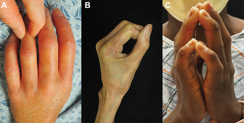 Figure 6 Cutaneous fibrosis starting at the distal fingers, as demonstrated by decreased skin mobility between the distal interphalangeal and proximal interphalangeal joints (A) is one of the hallmark features of systemic sclerosis. Over time, fibrosis extends proximally leading to difficulties forming a fist (B) and a positive “prayer sign” (C).