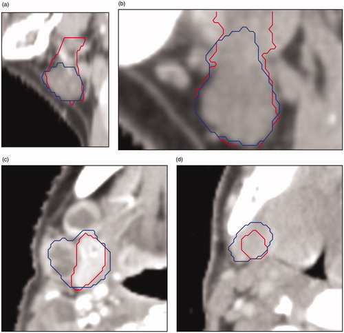 Figure 5. Four cases with low agreement between CC (in red) and DC (in blue) for the submandibular gland: (a) (sagittal plane) the CC encompasses to many slices in the upper part of the gland; (b) (sagittal plane) because of data properties (e.g., CT slice thickness) the gland does not fit inside the crop; (c) (transverse plane) anatomical deviation because of cancerous lymph nodes pressing against the gland; (d) (transverse plane) gland is difficult to distinguish from the surrounding tissue.